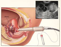Phương pháp bơm tinh trùng vào buồng tử cung giúp điều trị vô sinh – hiếm muộn