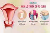 [ Không thể bỏ qua] 7+ Dấu hiệu viêm lộ tuyến cổ tử cung ở chị em phụ nữ