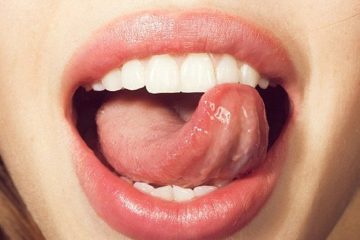 [Bệnh lậu ở họng] Nguyên nhân, triệu chứng và cách điều trị