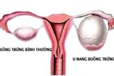 Bệnh u nang buồng trứng bên phải: Dấu hiệu & cách điều trị