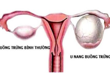 Bệnh u nang buồng trứng bên phải: Dấu hiệu & cách điều trị